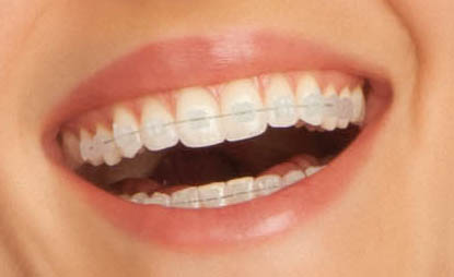 clear braces